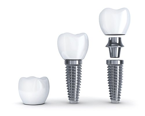 Diagram of dental implant pieces used by Dr. Hosseini in San Antonio, TX.