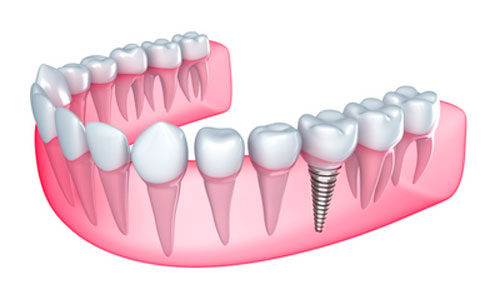 Dental Implants Help Preserve Your Facial Features
