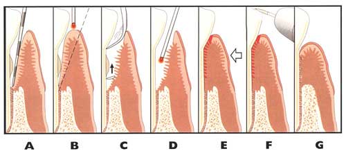 Illustration of the LANAP® laser therapy process.