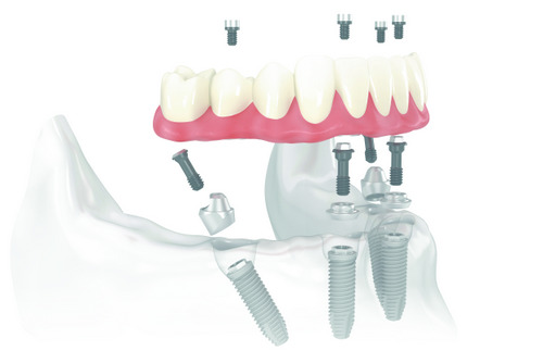 Diagram of All on 4 Dental Implant Treatment from Aesthetic Periodontal & Implant Specialists