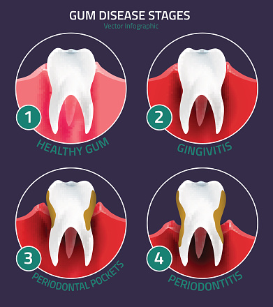 illustration of stages of gingivitis - including periodontal pockets