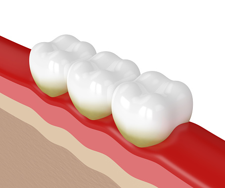 Digital illustration showing three teeth with indications of gum disease stages