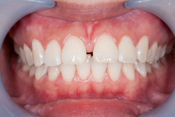 Close-up of teeth with a gap at Aesthetic Periodontal & Implant Specialists
