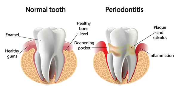 Side by side drawings comparing a healthy tooth with another tooth suffering from periodontal disease.