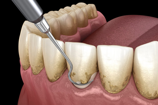 digital rendering of a scaling tool removing residue from a tooth at Aesthetic Periodontal & Implant Specialists in Florence, AL