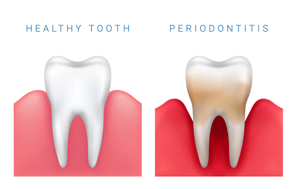 Diagram of healthy tooth compared to periodontitis diseased tooth