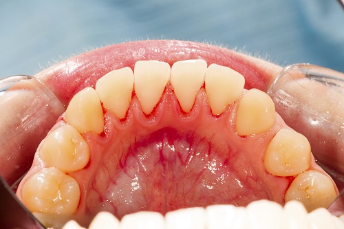 What are the risk factors for periodontal disease?
