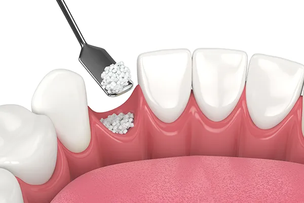 Bone graft material is placed into a missing tooth socket in the gum tissue, using a tool.