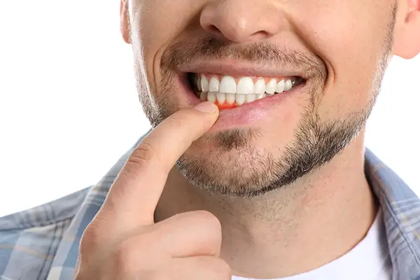 Close-up of a man pointing to his bleeding gums, a common symptom of periodontal disease, stressing the need for treatment.